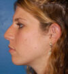 Rhinoplasty case #13071