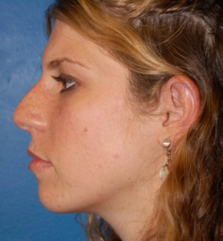 Rhinoplasty case #13071