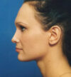 Rhinoplasty case #13097