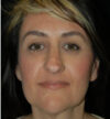 Rhinoplasty case #13074