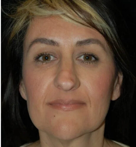 Rhinoplasty case #13074