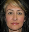 Rhinoplasty case #13074