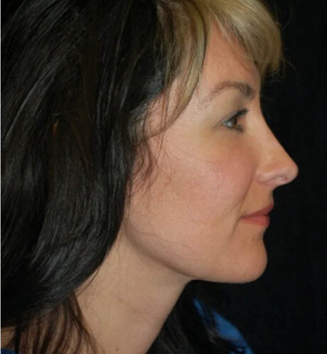Rhinoplasty case #13074