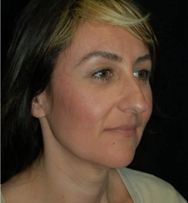 Rhinoplasty case #13074