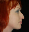 Rhinoplasty case #13081