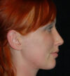 Rhinoplasty case #13081