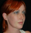 Rhinoplasty case #13081