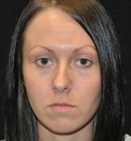 Rhinoplasty case #13090