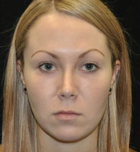 Rhinoplasty case #13090