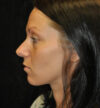 Rhinoplasty case #13090