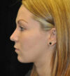Rhinoplasty case #13090