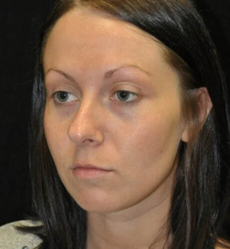 Rhinoplasty case #13090