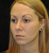 Rhinoplasty case #13090