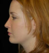 Rhinoplasty case #13110
