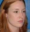 Rhinoplasty case #13110