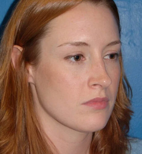 Rhinoplasty case #13110