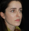 Rhinoplasty case #13120
