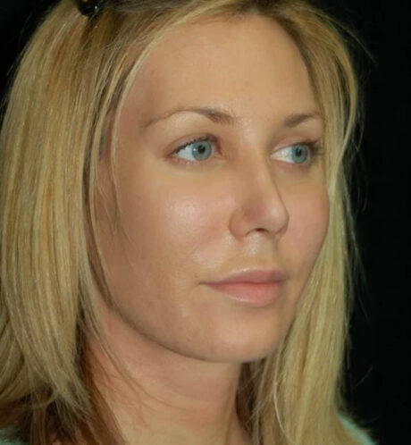 Rhinoplasty case #13129