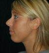 Rhinoplasty case #13134