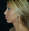 Rhinoplasty case #13134