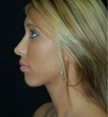 Rhinoplasty case #13134