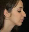 Rhinoplasty case #13137