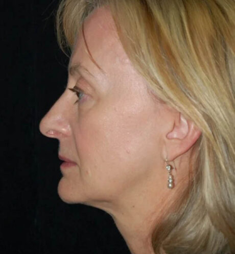 Rhinoplasty case #13140