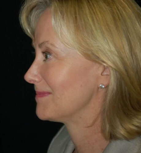 Rhinoplasty case #13140