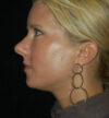 Rhinoplasty case #13147