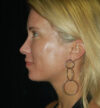 Rhinoplasty case #13147