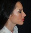 Rhinoplasty case #13156