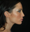 Rhinoplasty case #13156