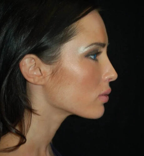 Rhinoplasty case #13156