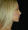 Rhinoplasty case #13159