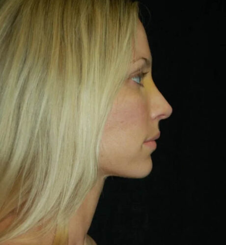 Rhinoplasty case #13159