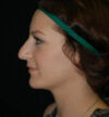 Rhinoplasty case #13162