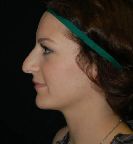 Rhinoplasty case #13162