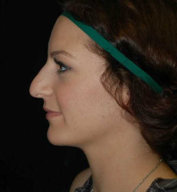 Rhinoplasty case #13162