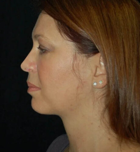 Rhinoplasty case #13165