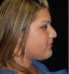 Rhinoplasty case #13170