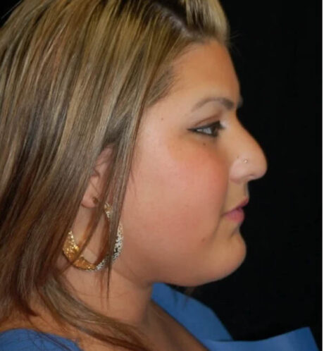 Rhinoplasty case #13170
