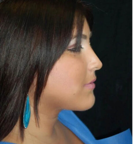 Rhinoplasty case #13170