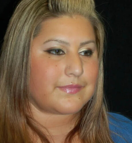 Rhinoplasty case #13170