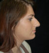 Rhinoplasty case #13175