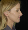 Rhinoplasty case #13186