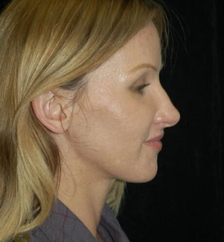 Rhinoplasty case #13186