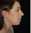 Rhinoplasty case #13190