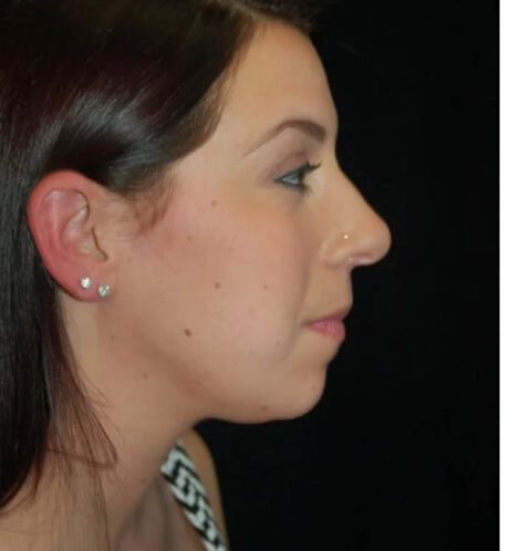 Rhinoplasty case #13190