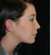 Rhinoplasty case #13190