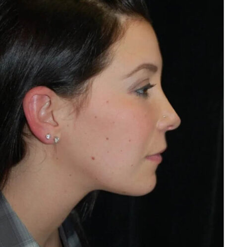 Rhinoplasty case #13190